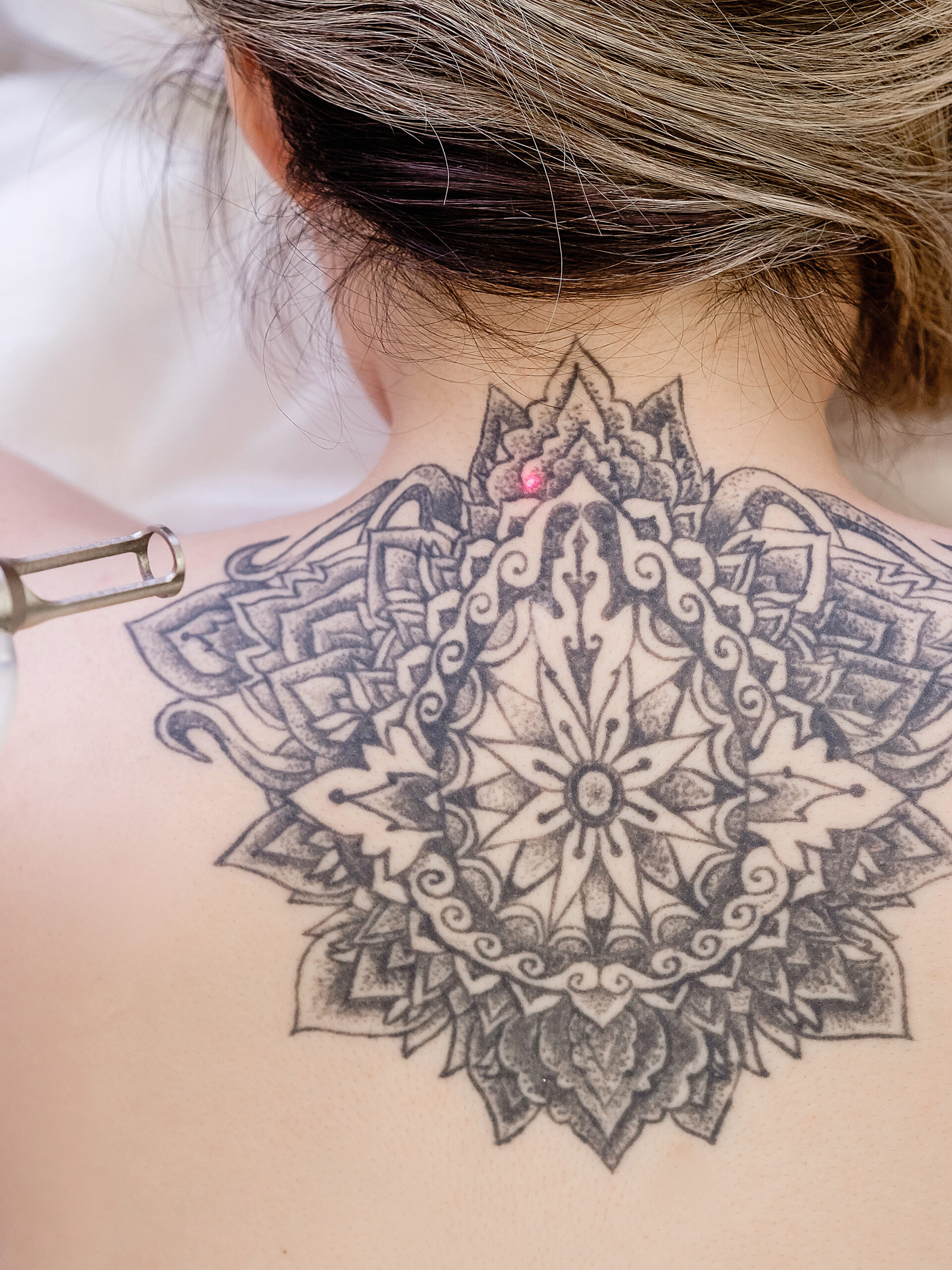 Tattoo Removal Treatment