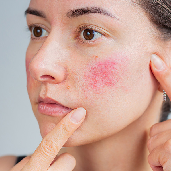 PDL Facial Redness and Vessels Treatment