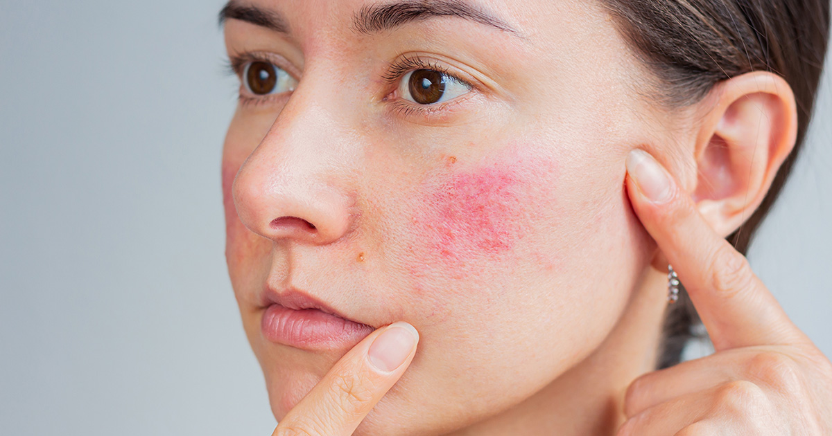 PDL Facial Redness and Vessels Treatment