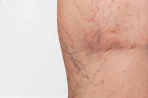 Close up of spider veins on female thigh, varicose vascular network and skin condition. High quality photo