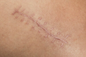 The Scar