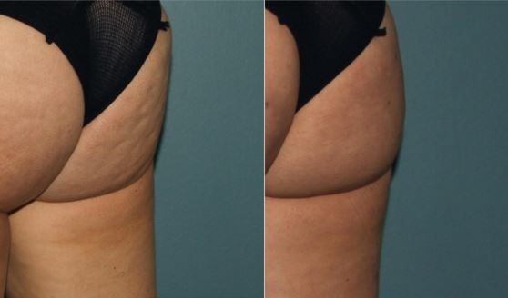 Cellulite before and after