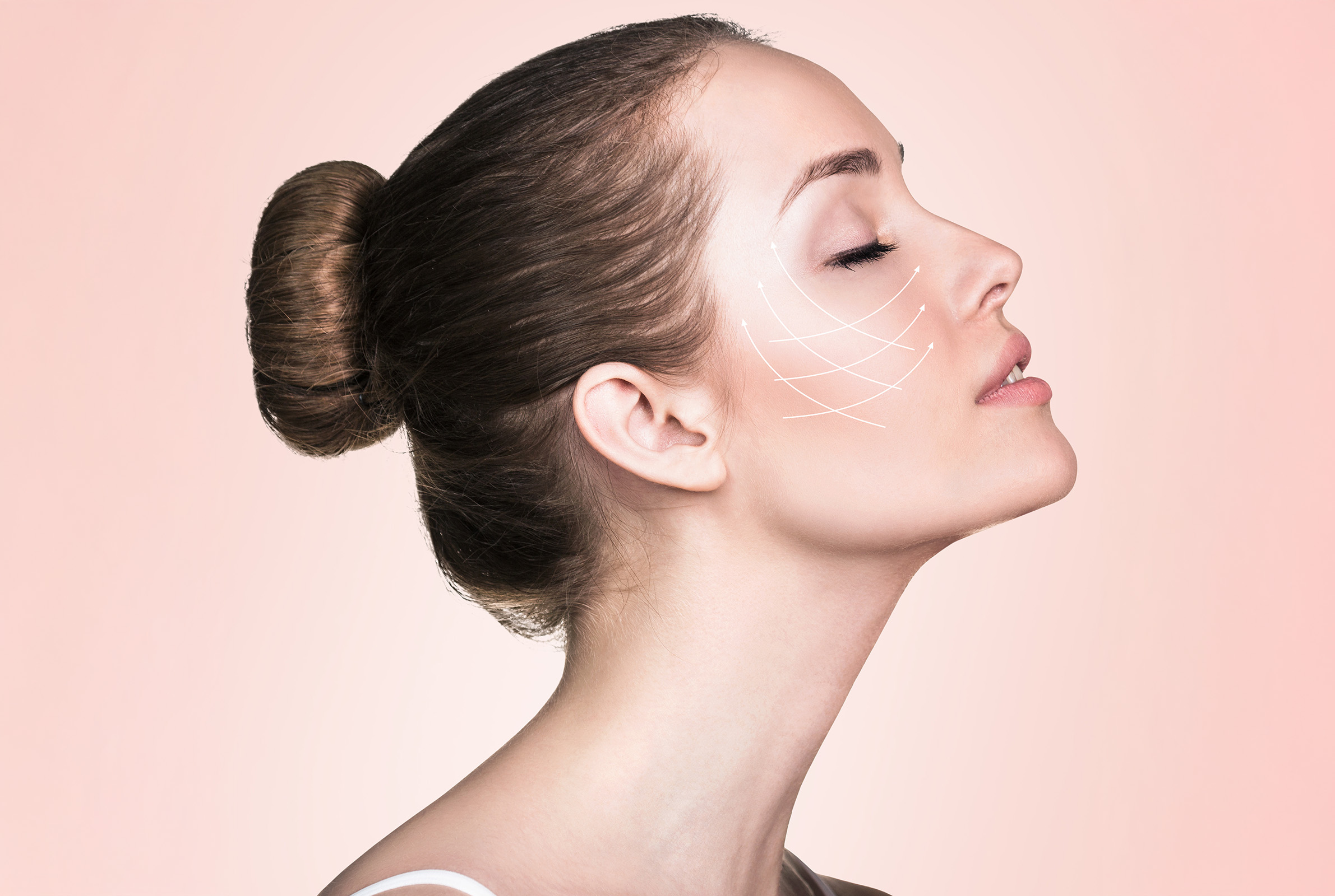 Before and After Profound RF Treatment
