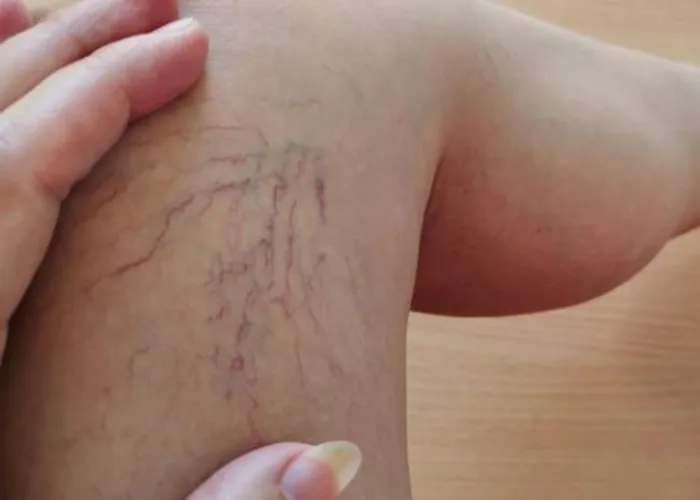 Varicose Veins and Pregnancy: When to Consult a Doctor