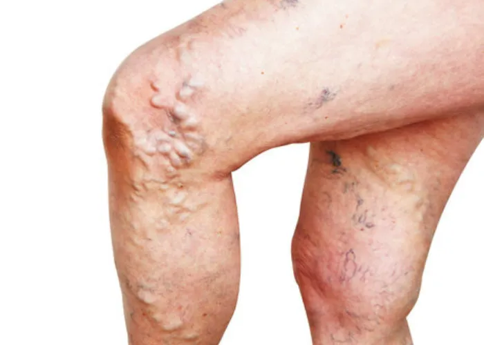 When You Should Worry about Varicose Veins