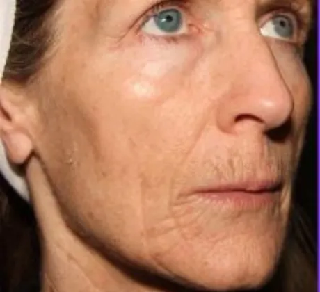 skin-resurfing-before