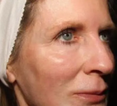 skin-resurfing- after