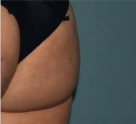 Cellulite-Reduction-after