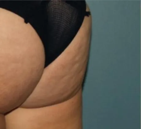 Cellulite-Reduction-before