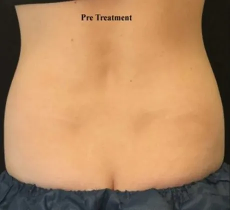 Coolsculpting-before