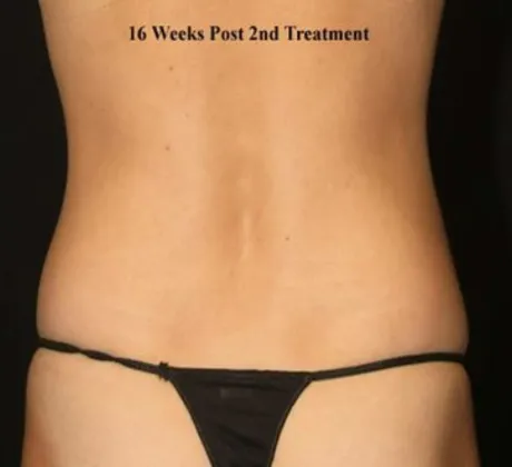 Coolsculpting-after