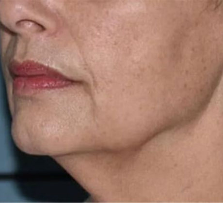 Laser-facials-before