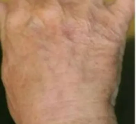 Pigment-Reduction-after