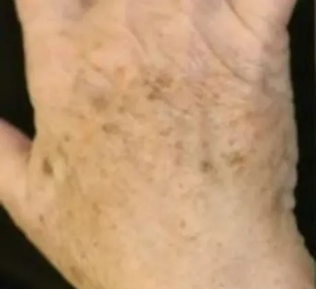 Pigment-Reduction-before