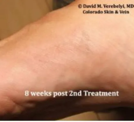 Tattoo-removal-after