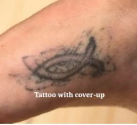 Tattoo-removal-before