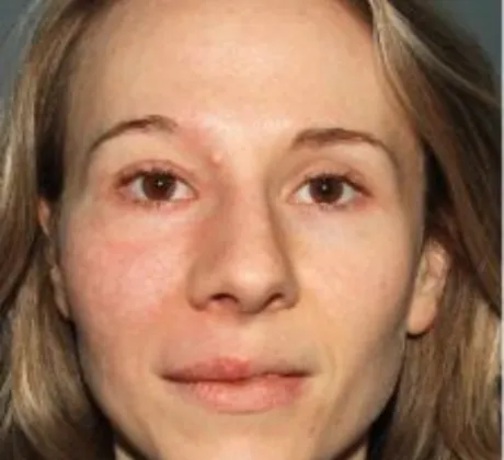 port-wine-stains-after