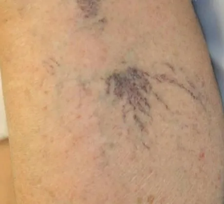 spider-vein-before