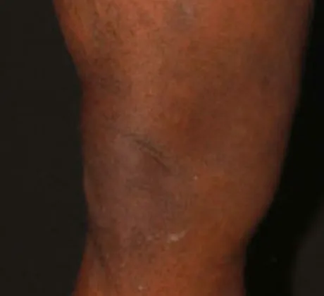 varicose-veins-after