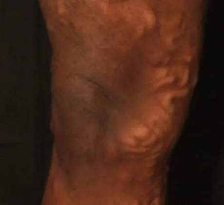 varicose-veins-before