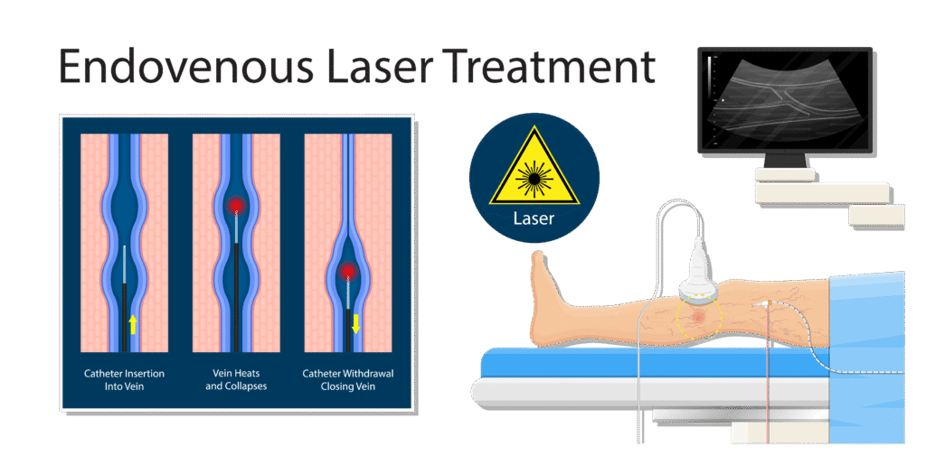 Ambulatory Phlebectomy for Varicose Veins