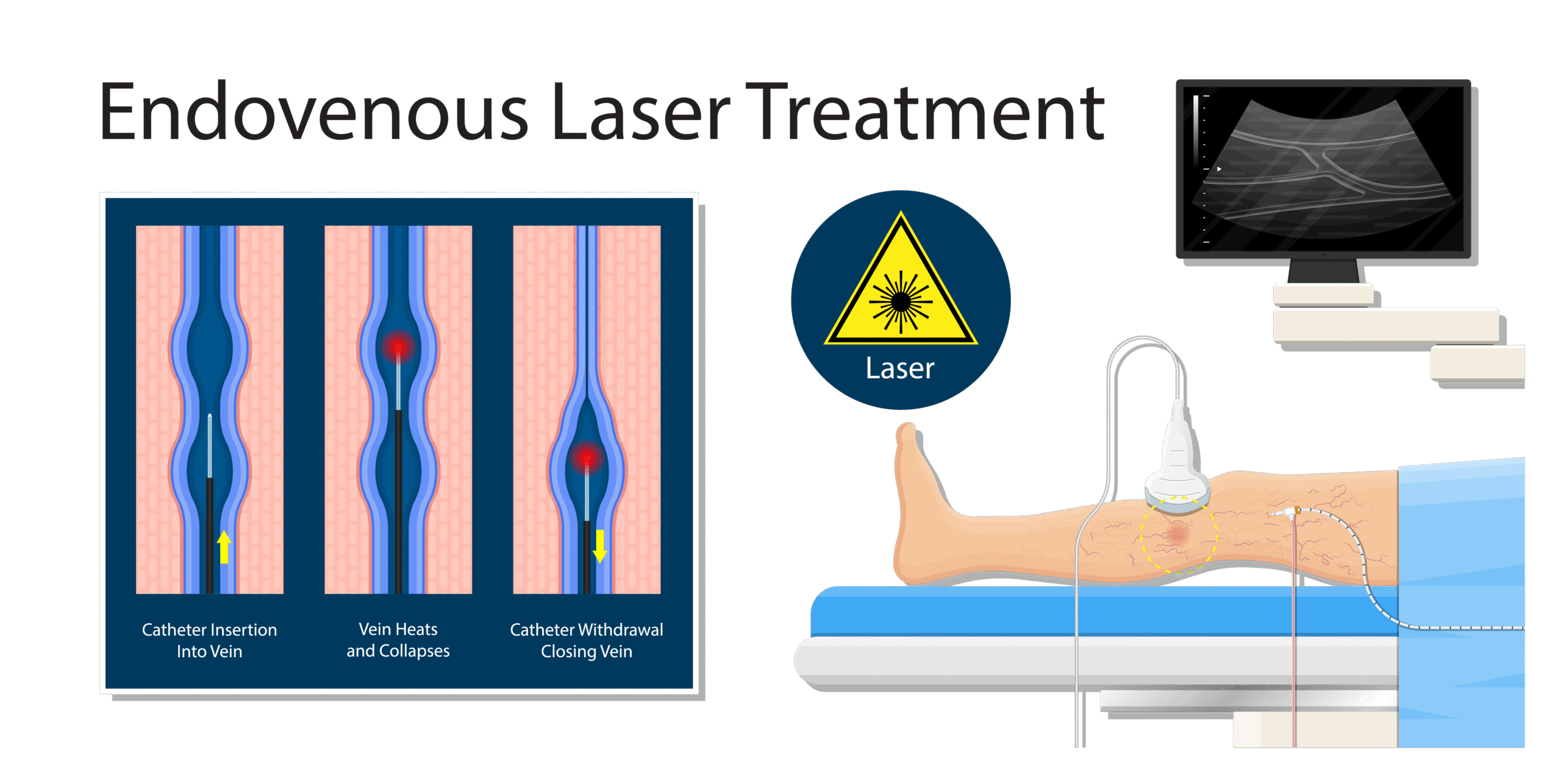 Ambulatory Phlebectomy for Varicose Veins