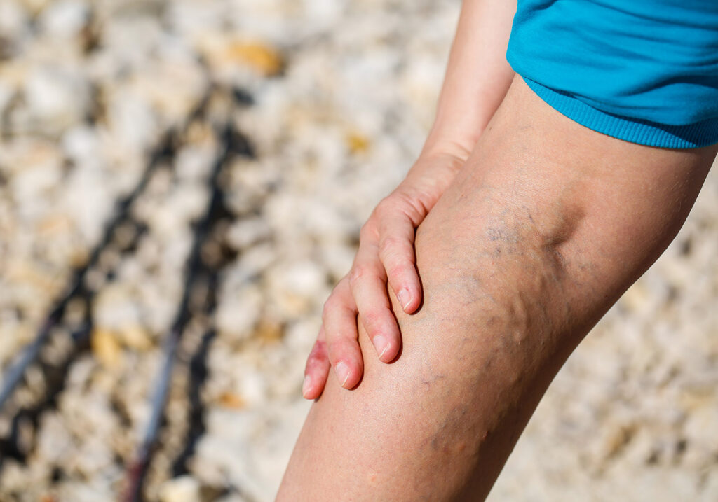 deep vein thrombosis symptoms