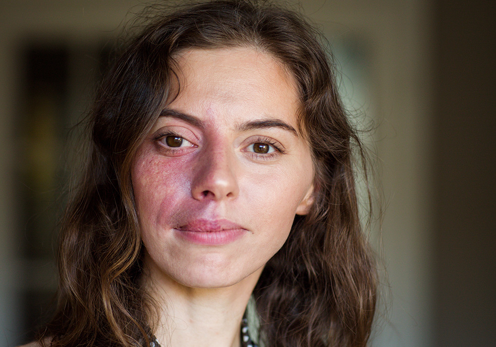 Port Wine Stain Treatment