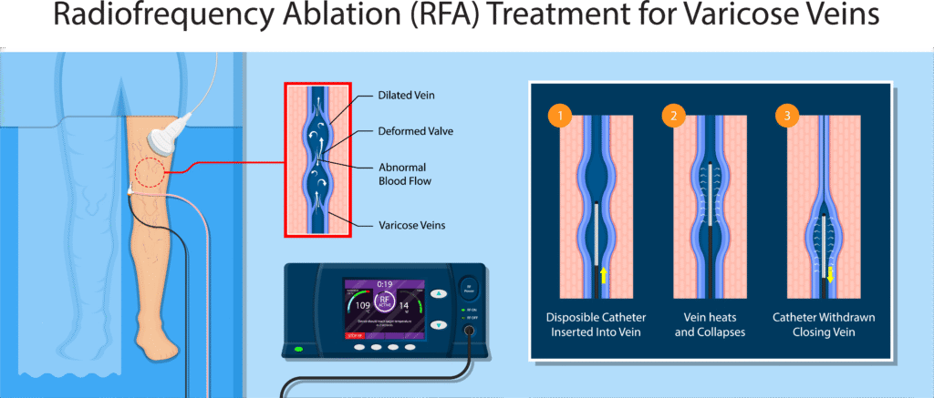 Radiofrequency Ablation Procedure