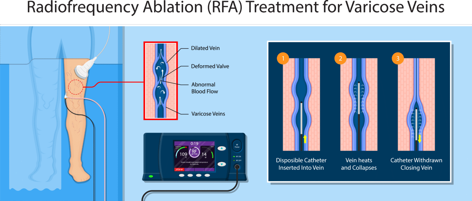 Knee Rfa Procedure Radiofrequency Ablation for Varicose Veins | RFA Treatment Denver ...
