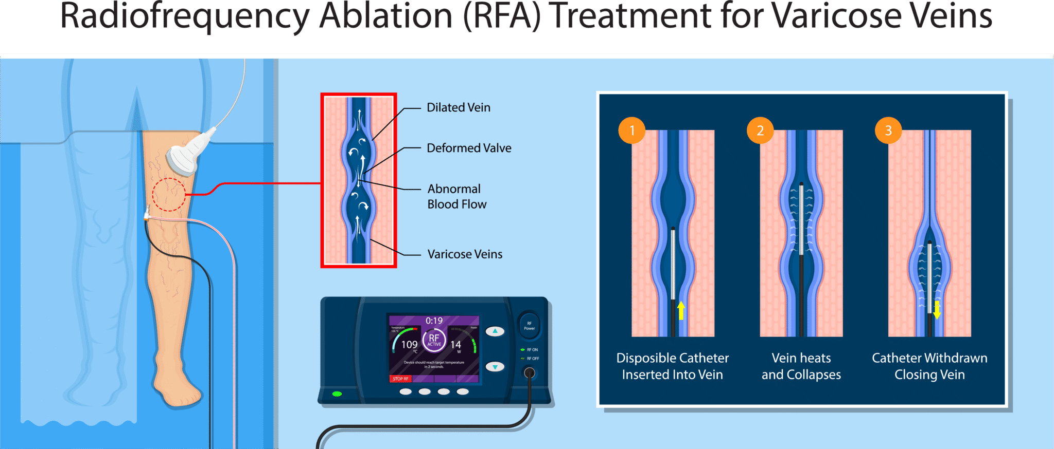 Perforator Rfa Radiofrequency Ablation for Varicose Veins | RFA Treatment Denver ...
