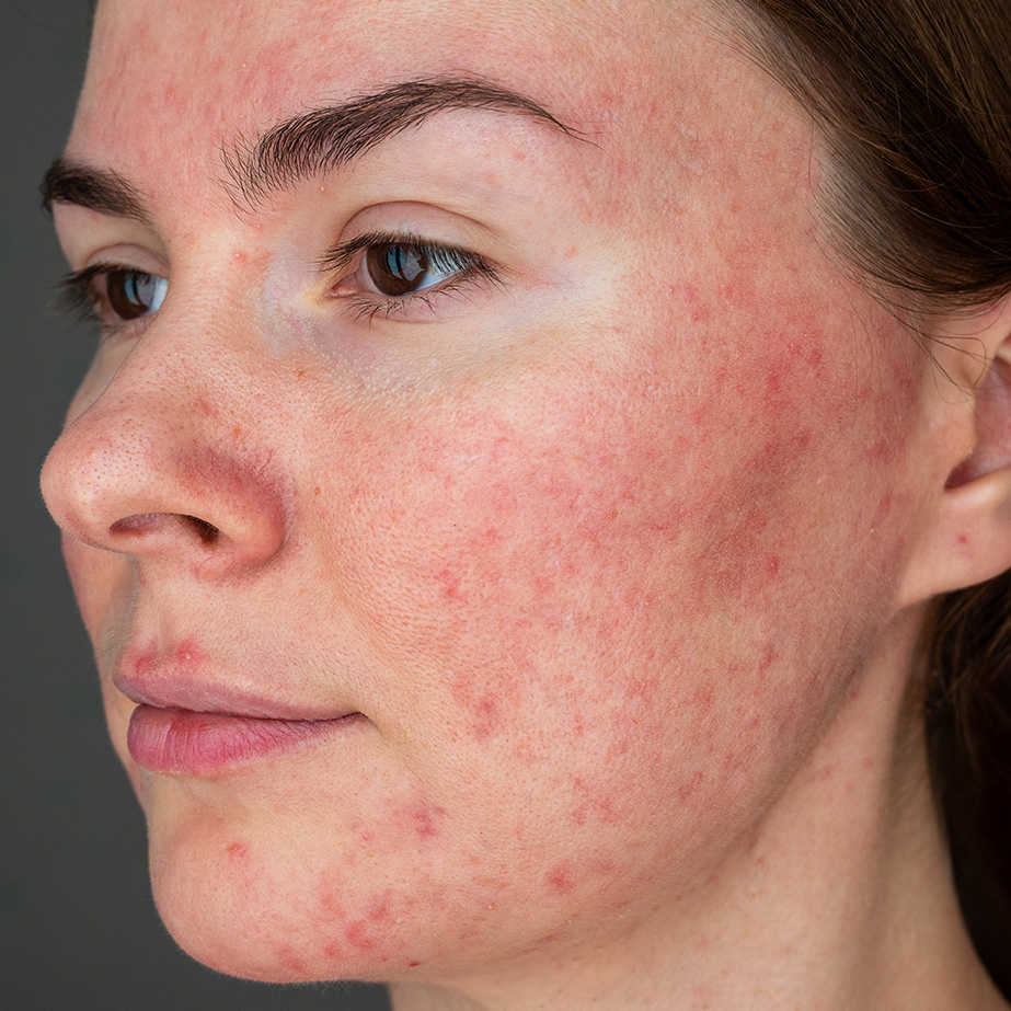 rosacea woman face