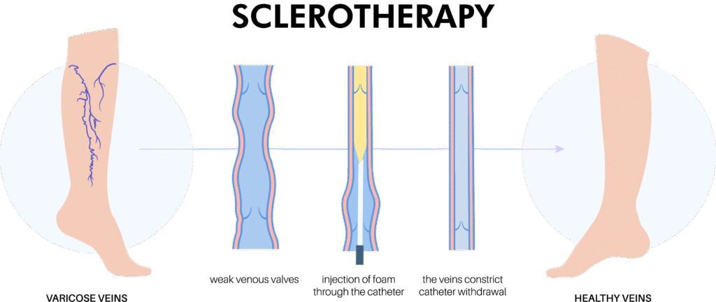 Sclerotherapy for Varicose Veins