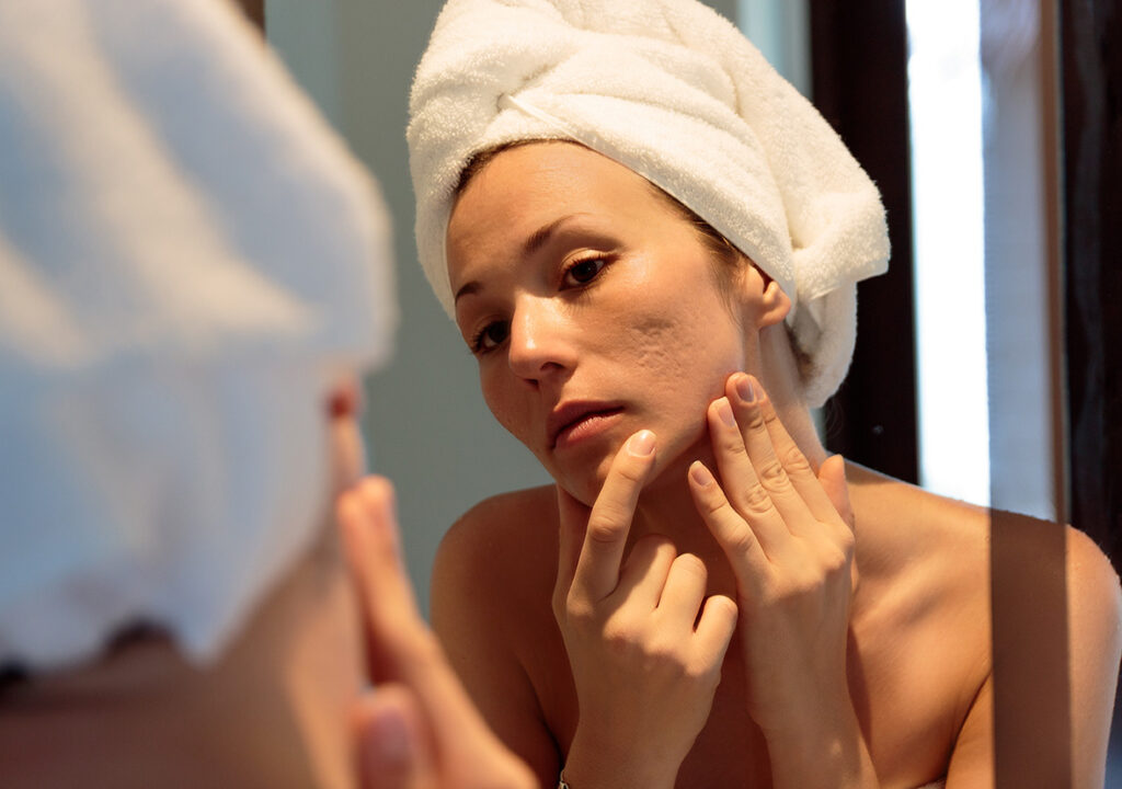 Acne Scar Treatment: Clear Skin, Renewed Confidence