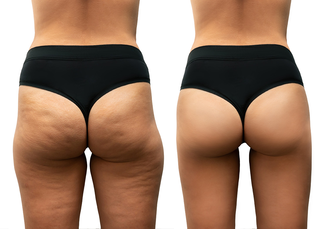 Cellulite Treatment Denver | Cellulite Fat Loss