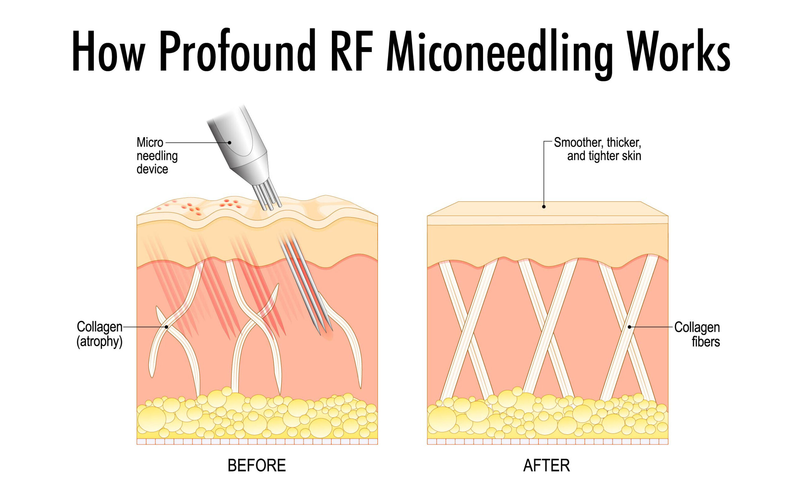 how profound microneedling works