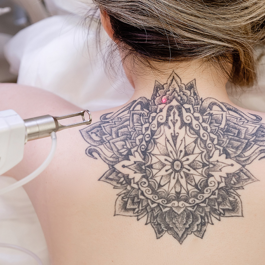 laser-tattoo-removal-hero