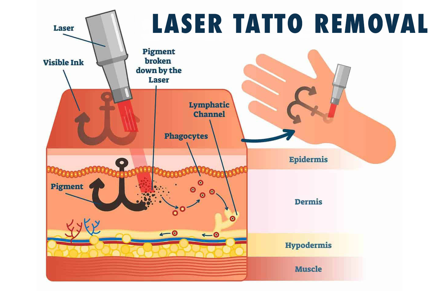 laser-tattoo-removal-how-it-works