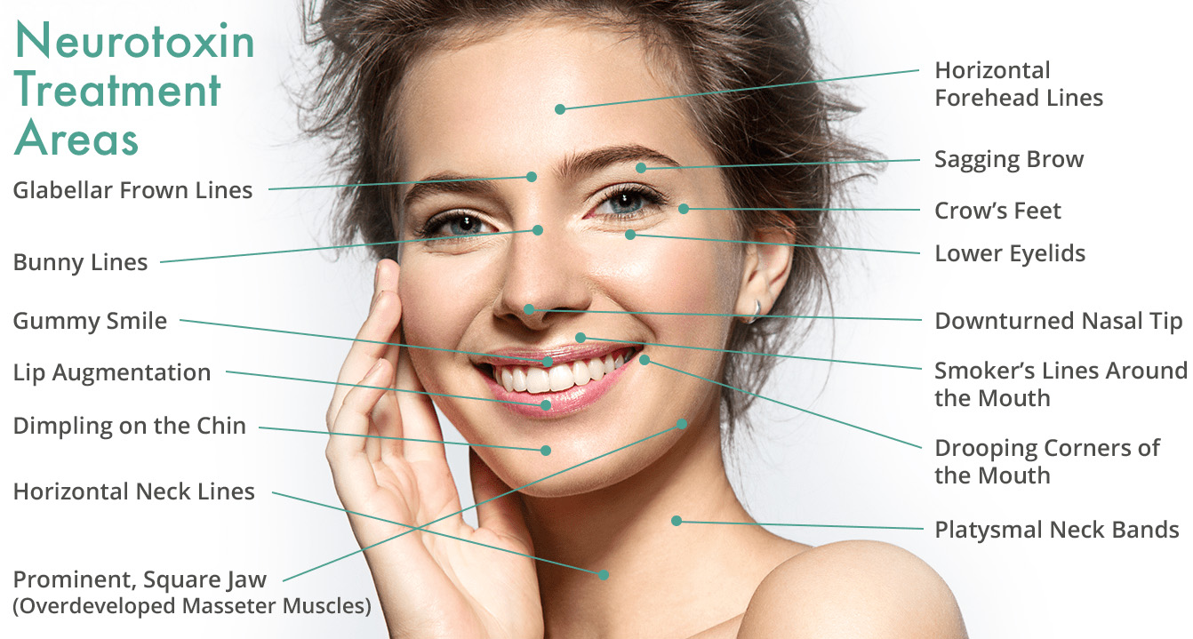 neurotox treatment areas final