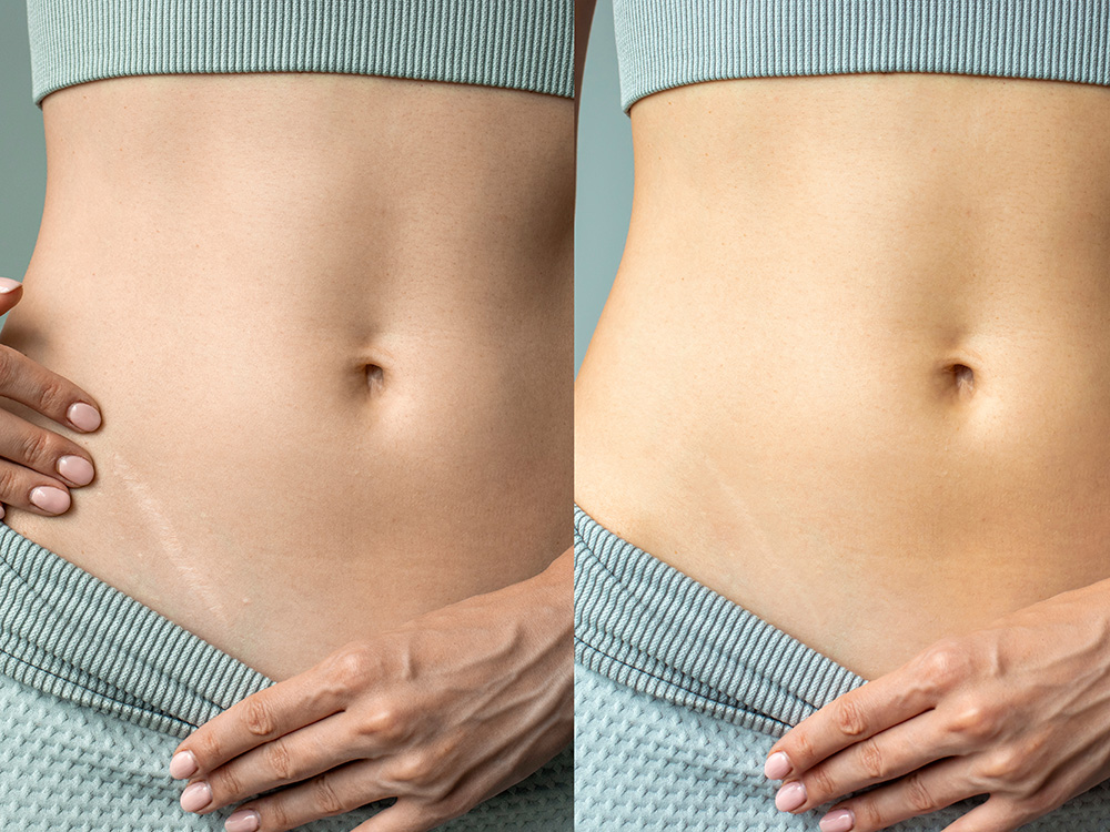 Scar Revision Treatments