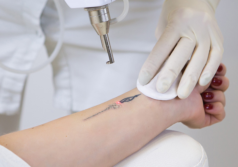 unwanted-tattoo-removal-laser-hero