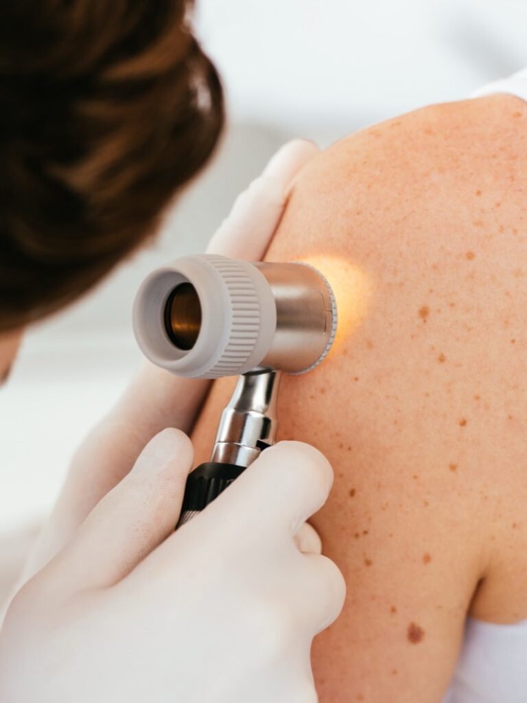 Dermatology provider using a handheld dermatoscope for a mole exam and skin check at Colorado Skin & Vein in Denver
