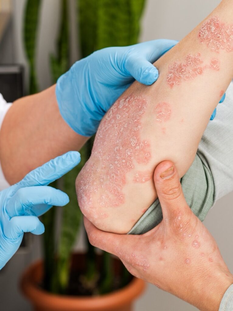 Dermatology provider in gloves examining psoriasis plaques on a patient's elbow